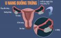 u-nang-buong-trung-la-gi-nguyen-nhan-va-cach-dieu-tri